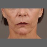 Facial Fat Grafting Before & After Patient #1255