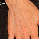 Fat Grafting to The Hands Before & After Patient #1279