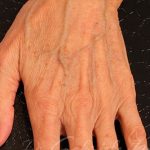 Fat Grafting to The Hands Before & After Patient #1279