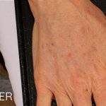 Fat Grafting to The Hands Before & After Patient #1279