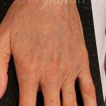 Fat Grafting to The Hands Before & After Patient #1279