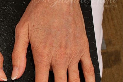 Fat Grafting to The Hands Before & After Patient #1279