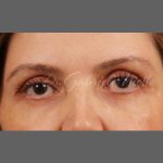 Facial Fat Grafting Before & After Patient #1254