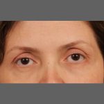 Facial Fat Grafting Before & After Patient #1254