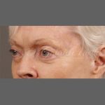 Facial Fat Grafting Before & After Patient #1253