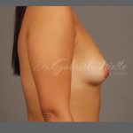 Fat Transfer Breast Augmentation Before & After Patient #1516