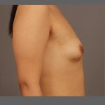 Fat Transfer Breast Augmentation Before & After Patient #1516