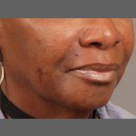 Softening of Facial Creases Wrinkles Before & After Patient #1377