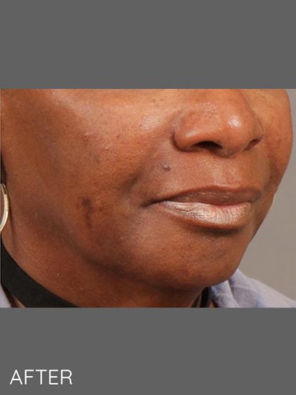 Softening of Facial Creases Wrinkles Before & After Patient #1377