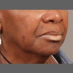 Softening of Facial Creases Wrinkles Before & After Patient #1377