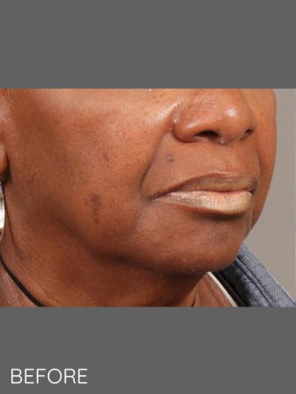 Softening of Facial Creases Wrinkles Before & After Patient #1377