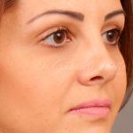 Dark Circles and Eyelid Bags Before & After Patient #1408