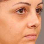 Dark Circles and Eyelid Bags Before & After Patient #1408