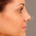 Dark Circles and Eyelid Bags Before & After Patient #1408