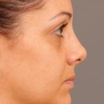 Dark Circles and Eyelid Bags Before & After Patient #1408