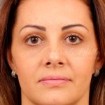Dark Circles and Eyelid Bags Before & After Patient #1408