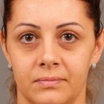 Dark Circles and Eyelid Bags Before & After Patient #1408