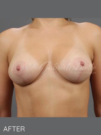 Breast Lift Before & After Patient #1640