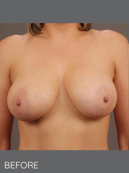 Breast Lift Before & After Patient #1640