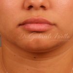 Lip Augmentation Before & After Patient #1371