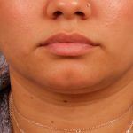 Lip Augmentation Before & After Patient #1371