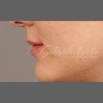 Lip Augmentation Before & After Patient #1375