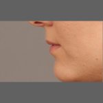 Lip Augmentation Before & After Patient #1375