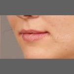 Lip Augmentation Before & After Patient #1375