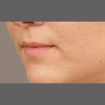 Lip Augmentation Before & After Patient #1375