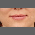 Lip Augmentation Before & After Patient #1375