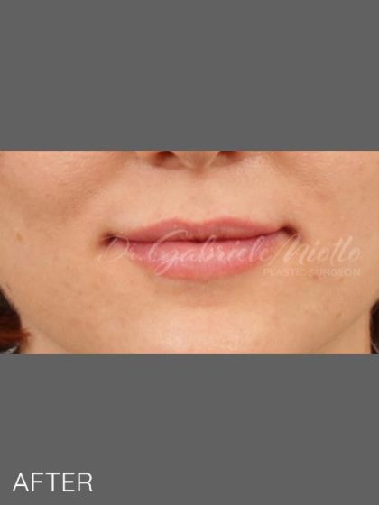 Lip Augmentation Before & After Patient #1375