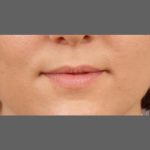 Lip Augmentation Before & After Patient #1375