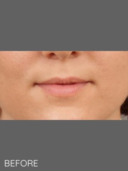 Lip Augmentation Before & After Patient #1375