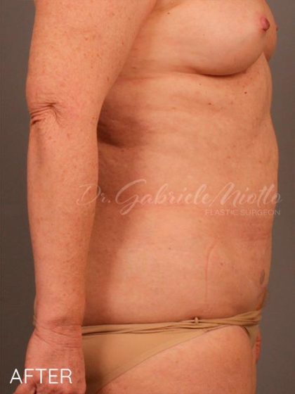 Liposuction Before & After Patient #1686