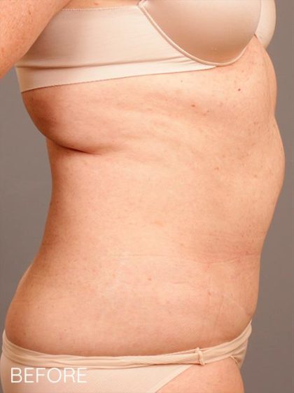 Liposuction Before & After Patient #1686