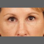 Dark Circles and Eyelid Bags Before & After Patient #1407