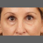 Dark Circles and Eyelid Bags Before & After Patient #1407