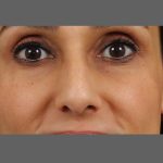 Non Surgical Rhinoplasty Before & After Patient #1317