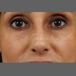 Non Surgical Rhinoplasty Before & After Patient #1317