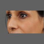 Non Surgical Rhinoplasty Before & After Patient #1317