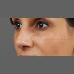 Non Surgical Rhinoplasty Before & After Patient #1317
