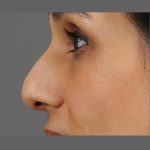Non Surgical Rhinoplasty Before & After Patient #1317