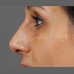 Non Surgical Rhinoplasty Before & After Patient #1317