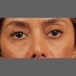 Non Surgical Rhinoplasty Before & After Patient #1316