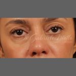 Non Surgical Rhinoplasty Before & After Patient #1316
