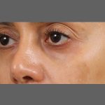 Non Surgical Rhinoplasty Before & After Patient #1316