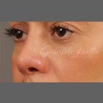 Non Surgical Rhinoplasty Before & After Patient #1316