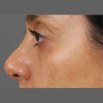 Non Surgical Rhinoplasty Before & After Patient #1316