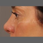 Non Surgical Rhinoplasty Before & After Patient #1316