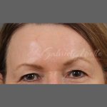 Skin Resurfacing Before & After Patient #1343